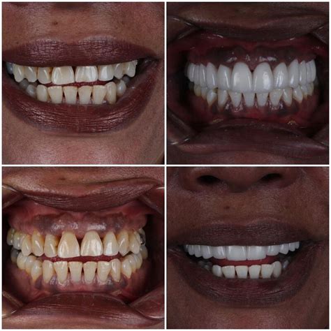 FACINGS TURKIJE HOLLYWOOD SMILE TURKIJE.